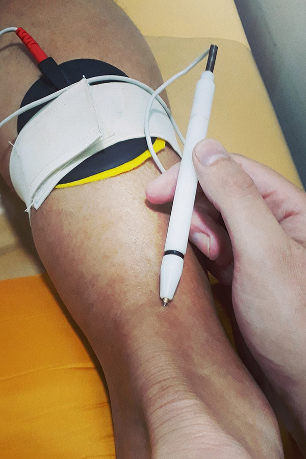 microelectrolisis percútanea